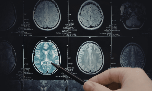 Largest Alzheimer's Genetic Study to Date, Published in Nature, Implicates Brain Immune Cells and Specific Neuron Types