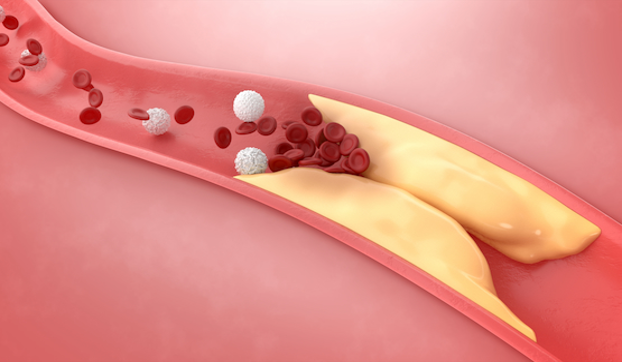 Single-Infusion CRISPR-Cas9 Therapy Shown to Safely Lower LDL Cholesterol in New Trial