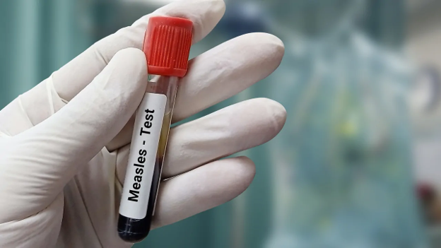CDC Reports US Measles Cases Rise to 4,080, Already 78% Above All of 2025's Full-Year Total